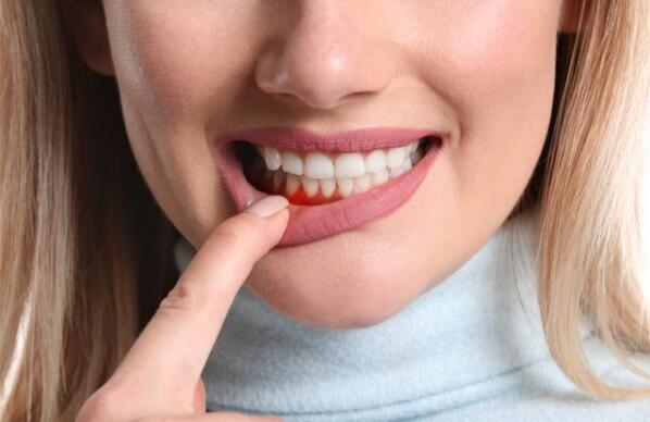 牙龈出血主要是因为这几种原因
