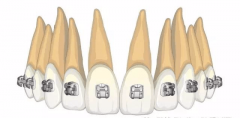 托槽定位总体原则：寻找临床牙冠的中心