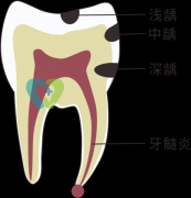补牙材料脱落是什么原因？
