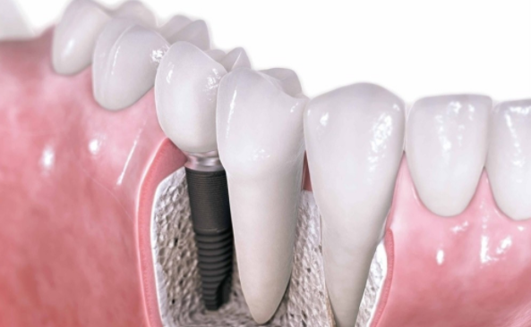 种植牙：人类的“第三副牙齿”并非人人都适用
