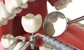 种植牙攻略：如何才能明明白白做种牙手术